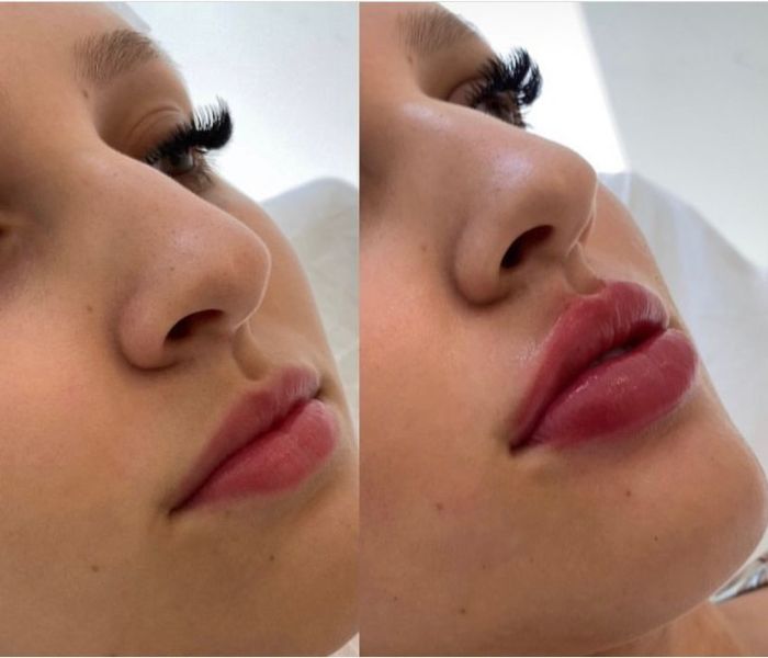 harmonização facial (700 × 600 px)